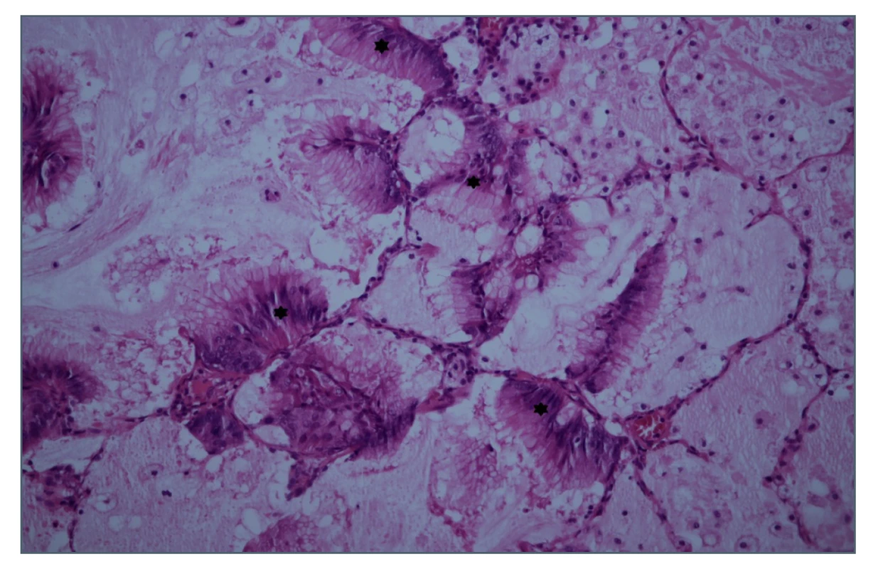 Histologický řez ložiskem v pravé plíci, hematoxylin-
eosin<br>
Hvězdičky označují ložiska tumoru.<br>
Fig. 5: Biopsy section of the right lung focus, HE staining<br>
Stars indicate the tumour foci.