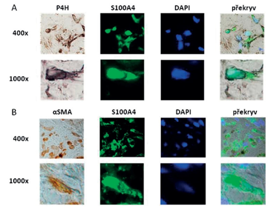 Kolokalizace exprese S100A4 s fibroblasty a myofibroblasty v SSc kůži.