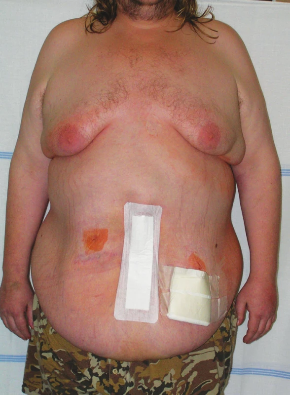 Stav druhý den po operaci
Fig. 9. Second day after operation