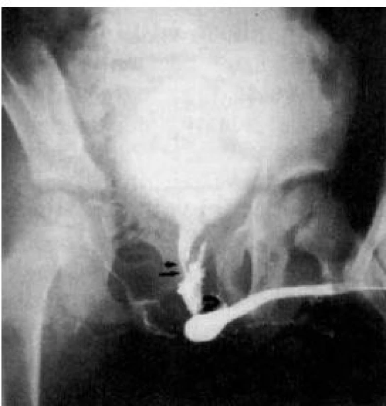 Ascendentní uretrocystografie u parciální ruptura membranózní uretry
Fig. 4. Ascendent urethrocystography in partial rupture of the membranous urethra