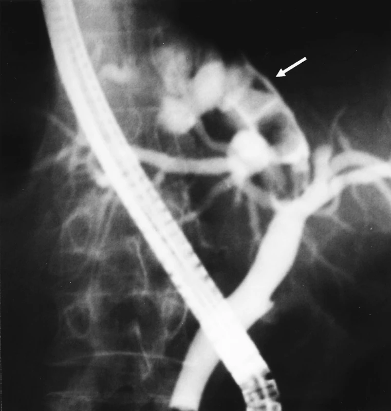 Endoskopická cholangiografie
Fig. 1. Endoscopic cholangiography
Šipka ukazuje defekty v náplni levého ductus hepaticus při masivní hepatikolitiáze.
An arrow indicates defects in the left hepatic duct filling in massive hepatolithiasis.