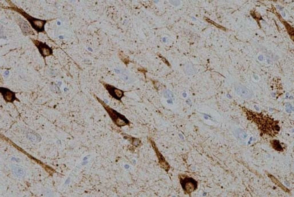 Neurofibrilární klubka-tangles a pretangles v hipokampu v imunohistochemickém barvení hyperfosforylovaným tau proteinem.
Fig. 1. Neurofibrillary tangles and pretangles in the hippocampus on immunohistochemical staining with hyperphosphorylated tau protein.