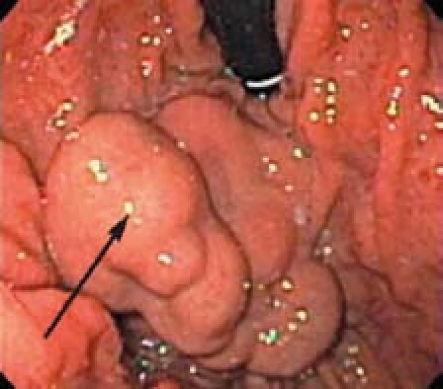 Gastrické varixy pri endoskopickom vyšetrení horného tráviaceho traktu [22].
Fig. 3. Gastric varices by endoscopic examination of the upper gastrointestinal tract [22].