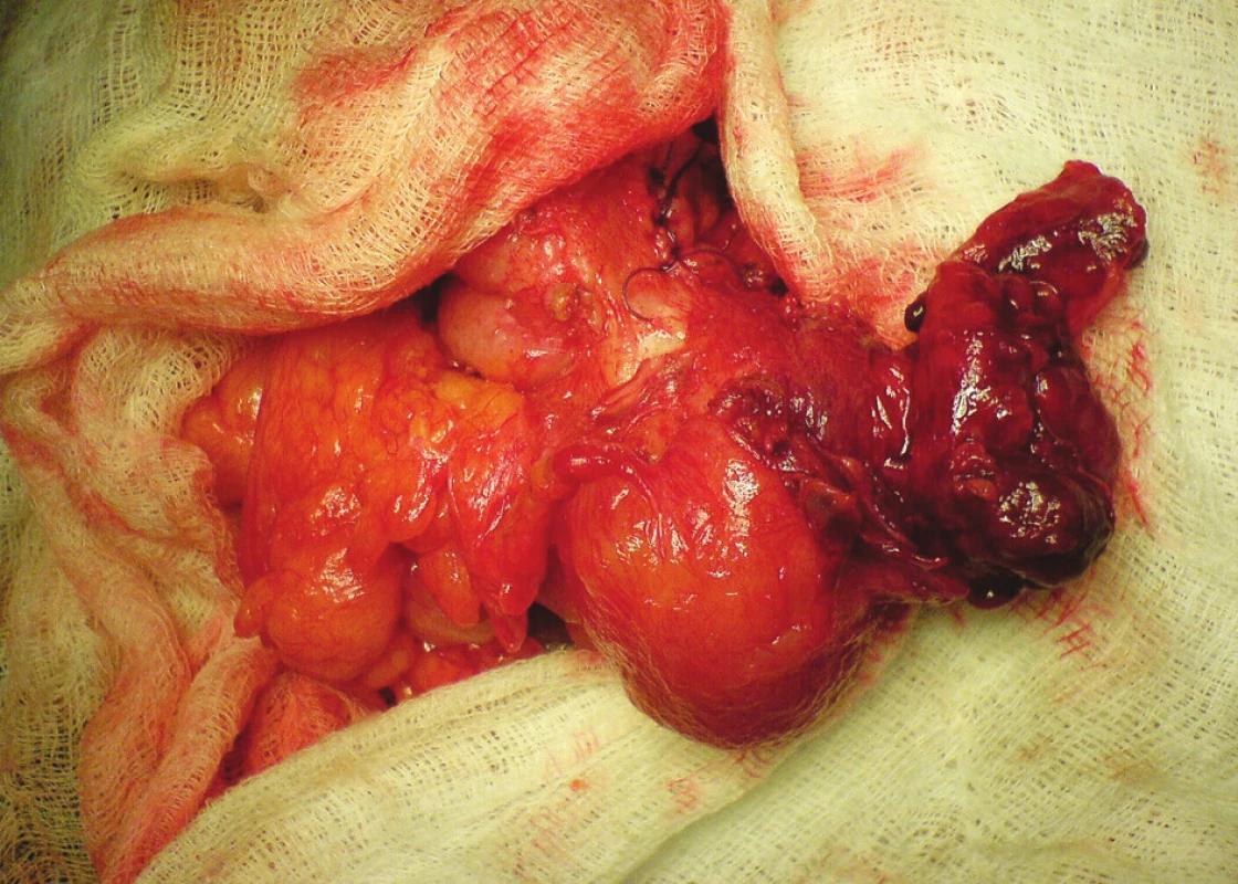 Peroperačný nález zapáleného pseudodivertikla
Fig. 2. Peroperative finding of inflamed pseudodiverticle