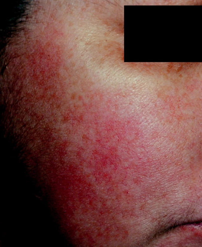 Erytematotelangiektatická rozacea.