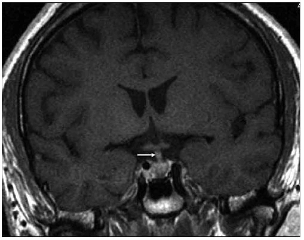 Při MR vyšetření v březnu roku 2008 byla patrná absence normálního hypersignálu v T1 váženém obraze, obvykle patrná v oblasti neurohypofýzy, a ložiskové zbytnění tkáně zde. Stopka hypofýzy byla v té době normální. T1 vážený MR obraz po aplikaci kontrastní látky ukazuje spíše normální vzhled stopky hypofýzy, snad jen nepatrné sporné zesílení v koronární rovině v březnu roku 2008.
