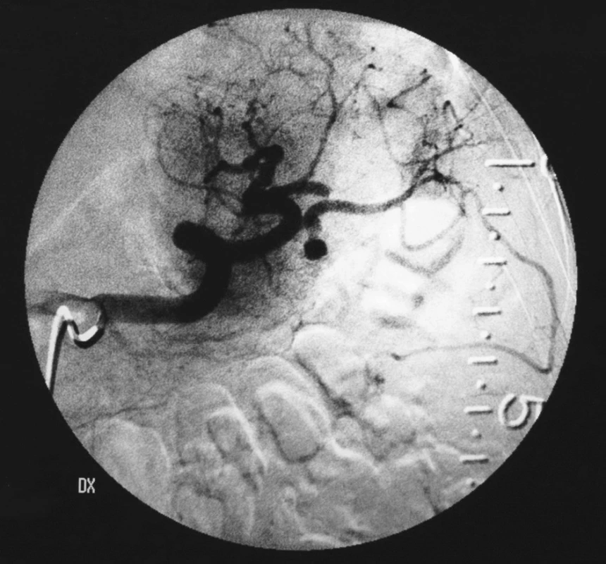 Selektívna angiografia arteria lienalis s drobnou vakovitou aneuryzmou s priemerom 5 mm s úzkym krčkom
Fig. 2. Selective angiography of arteria lienalis, with a minor sac-like aneurysm, 5mm in a diameter, with a narrow neck