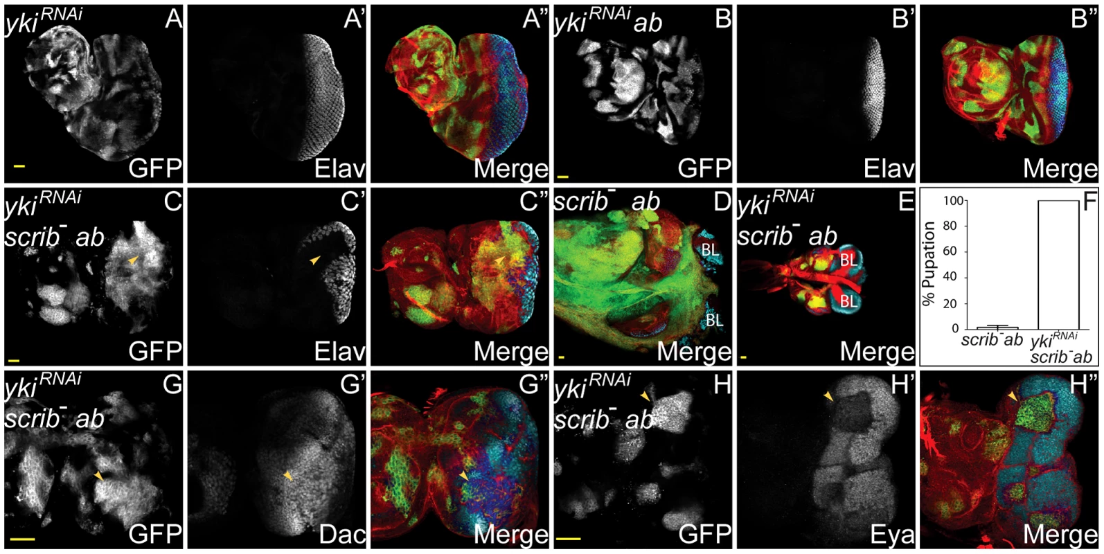 Yki is required for <i>scrib</i><sup>−</sup>+<i>ab</i> tumour overgrowth.