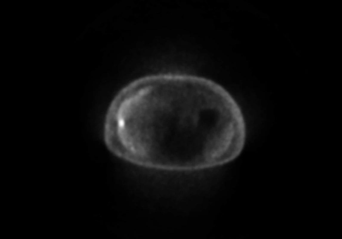 PET/CT vyšetření: shodný nemocný, jediné ložisko aktivity periferně v pravém jaterním laloku, odpovídá metastáze adenokarcinomu žaludku
Fig. 2: PET/CT: liver metastasis of gastric cancer in the same patient – small focus of increased metabolic activity in the right lobe of the liver