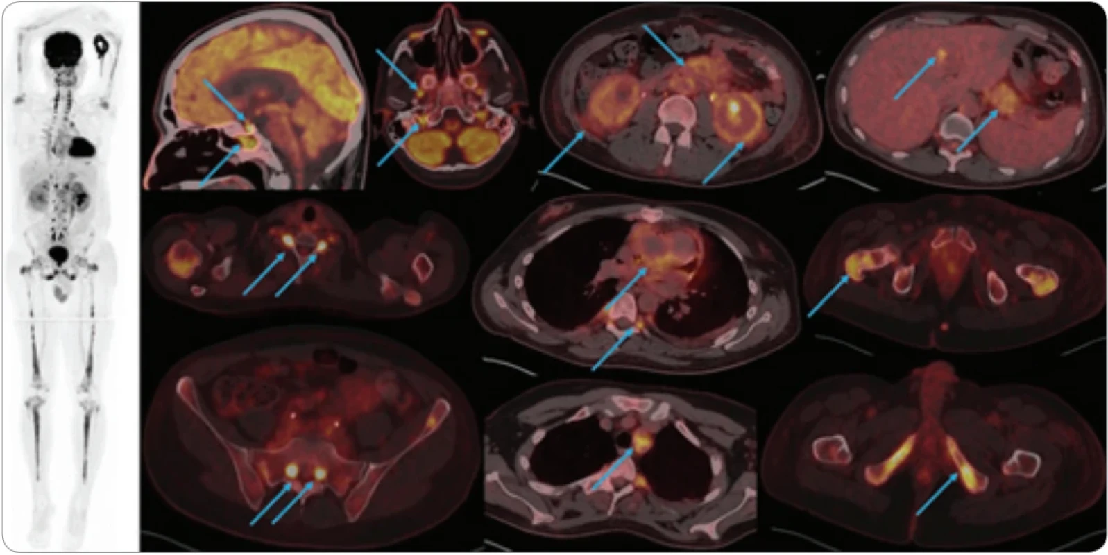  FDG-PET/CT vyšetření před zahájením léčby kladribinem. 