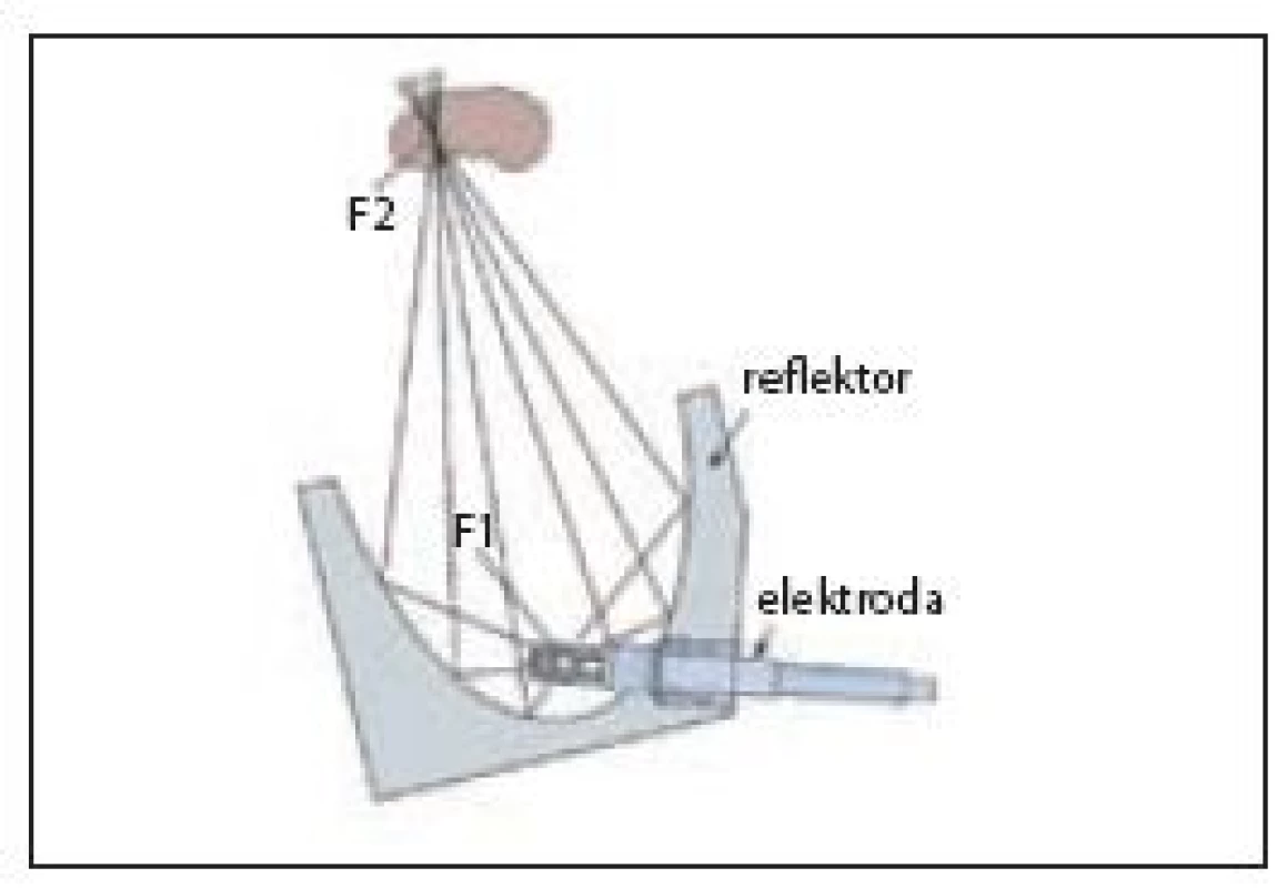 Elektrohydraulický princip generování rázové vlny
Fig. 5 Electrohydraulic shock wave generator