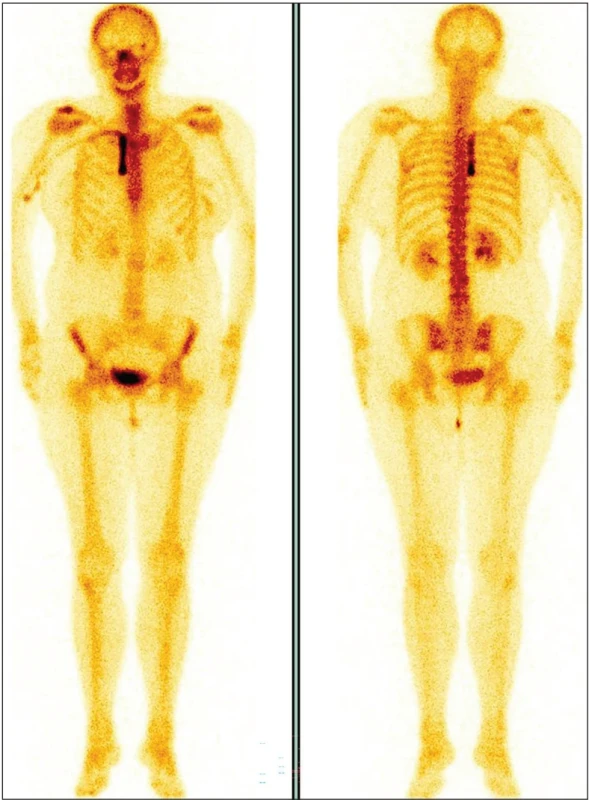 Celotělový (WB) snímek v pozdní (kostní) fázi s fyziologickou skeletální distribucí radiofarmaka bez známek metastatického postižení skeletu. V oblasti horního mediastina je patrná lineární akumulace v projekci centrálního katétru. Přední pohled vlevo, zadní vpravo.