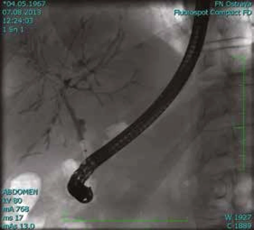 Pacient (1964): vyšetření ERCP.