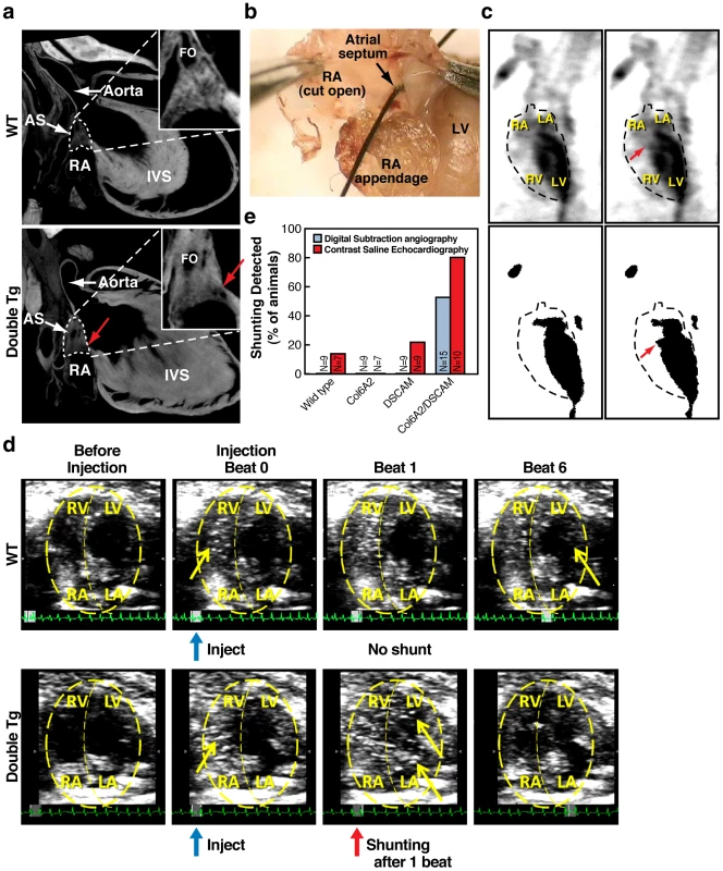 Atrial septal defects in DSCAM and COL6A2 double transgenic mice.