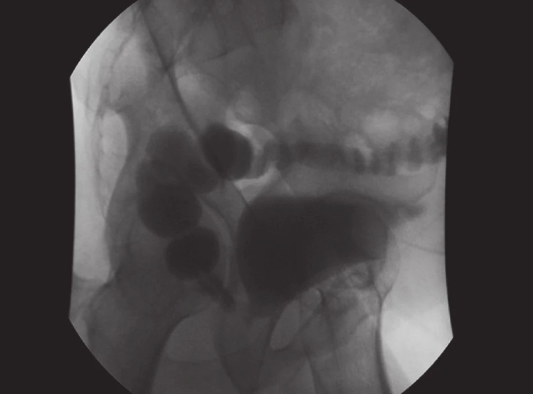 Cystografie s průkazem rektovezikální píštěle
Fig. 3. Cystography with the rectovesical fistula
