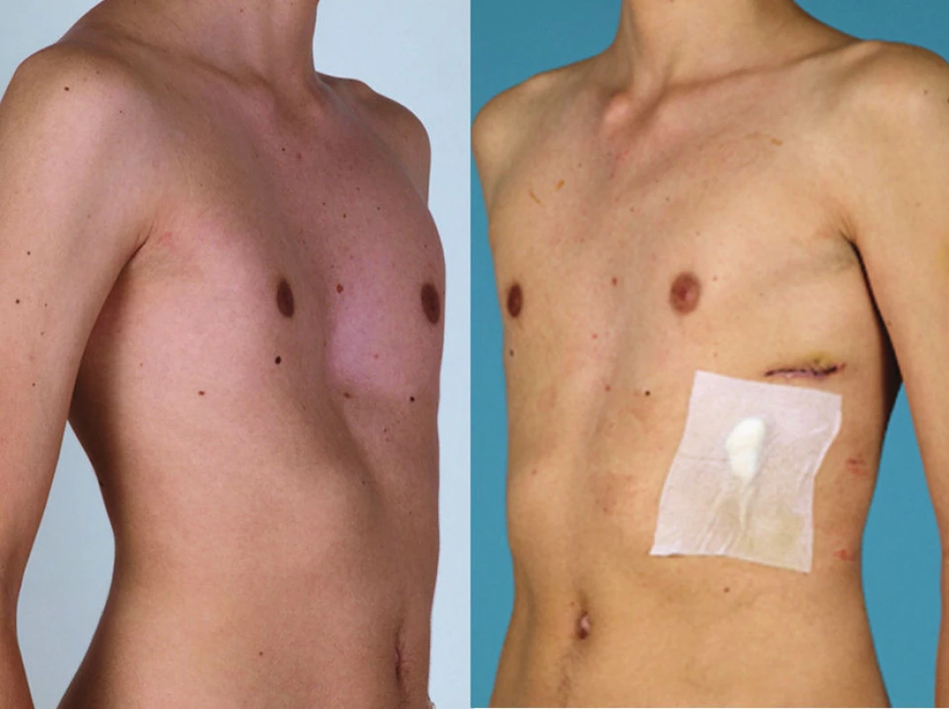 Předooperační a pooperační stav u pacienta po primární korekci PE Nussovou metodou
Fig. 3: Pre and postoperative view of the patient after the Nuss procedure