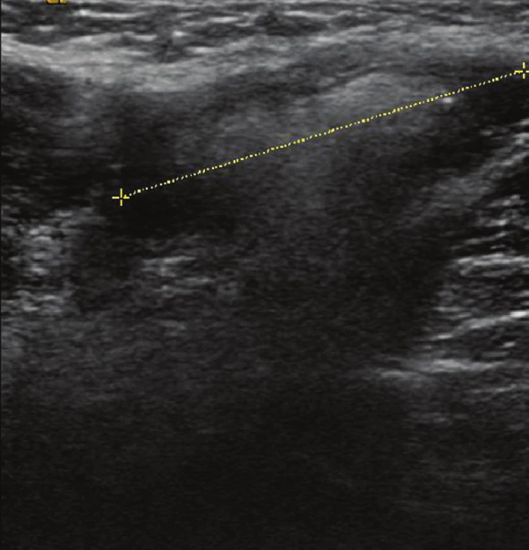 USG – zvětšené uzliny v levé axile s vymizelou diferenciací centra a kůry
Fig. 2: USG – Enlarged lymphatic nodes in the left axilla with no differentiation of centre and cortex