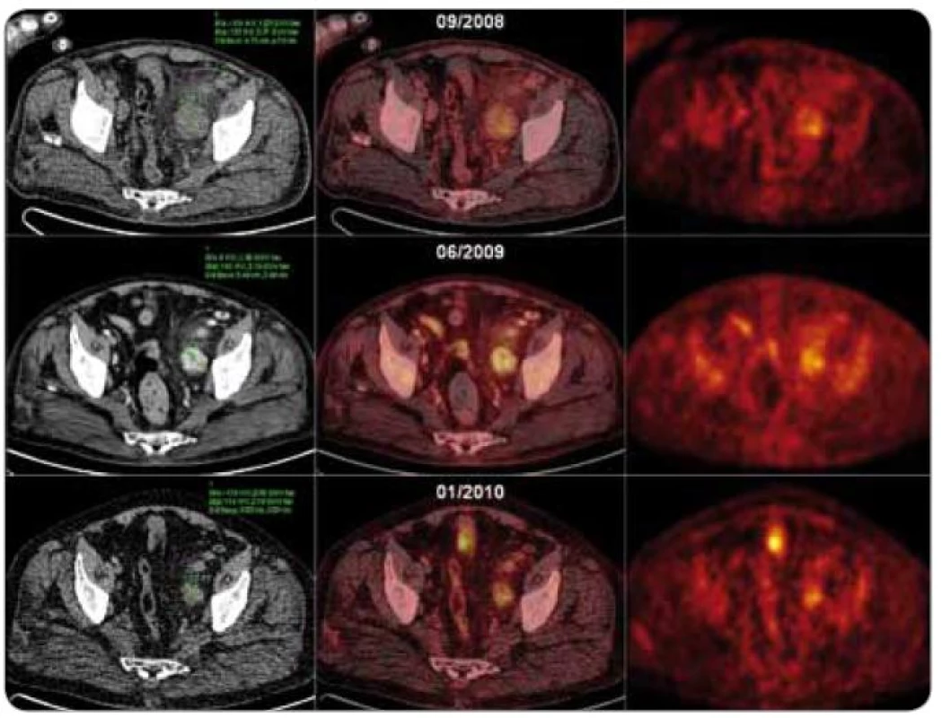 CT, fúzní PET /CT a PET axiální řezy nad úrovní stropu levého acetabula u pacienta s plazmocelulární multicentrickou Castlemanovou chorobou ukazující léčebný efekt režimu s thalidomidem.
09/2008, PET/low dose CT, vstupní vyšetření: zvětšená uzlina dorzálně od a. et v. iliaca externa vlevo (48 mm v maximálním příčném průměru) se zvýšenou akumulací radiofarmaka (SUV<sub>max</sub> = 4,21)
06/2009, PET/high dose CT, po 3 cyklech léčby: zvětšená uzlina dorzálně od a. et v. iliaca externa vlevo (35 mm v maximálním příčném průměru, postkontrastní denzita uzliny 180 HU) se zvýšenou akumulací radiofarmaka (SUV<sub>max</sub> = 4,16).
01/2010, PET/low dose CT, po 9 cyklech léčby: zvětšená uzlina dorzálně od a. et v. iliaca externa vlevo (30 mm v maximálním příčném průměru) se zvýšenou akumulací FDG (SUV<sub>max</sub> = 3,76).