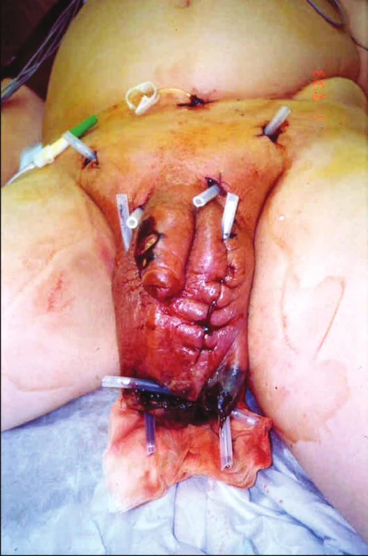 Iniciální lokální ošetření pacienta incizemi a kontraincizemi s drenáží z původního pracoviště (vhodná je excize tkání)
Pic. 1. The initial patient’s local treatment using the incision and secondary incisions with drainage from previous hospital (excision of tissue is proper)