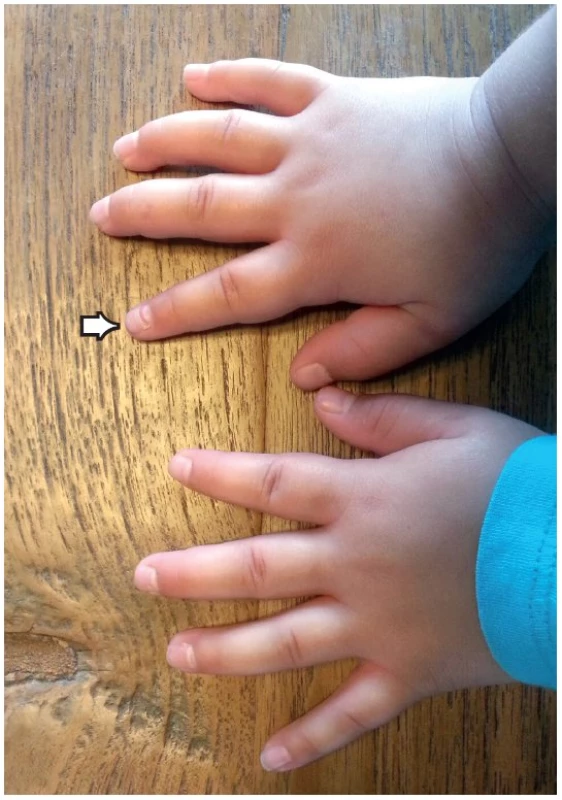 Postižení nehtů před onychomadesis – uvolnění od matrix nehtového lůžka.
Fig. 1. The impairment of the nails before shedding – release from the matrix of the nail bed.
