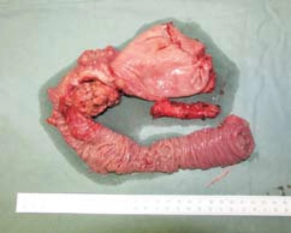 Karcinom hlavy pankreatu – makroskopie resekátu.
Fig. 1. Pancreatic head carcinoma – resected specimen macroscopy.