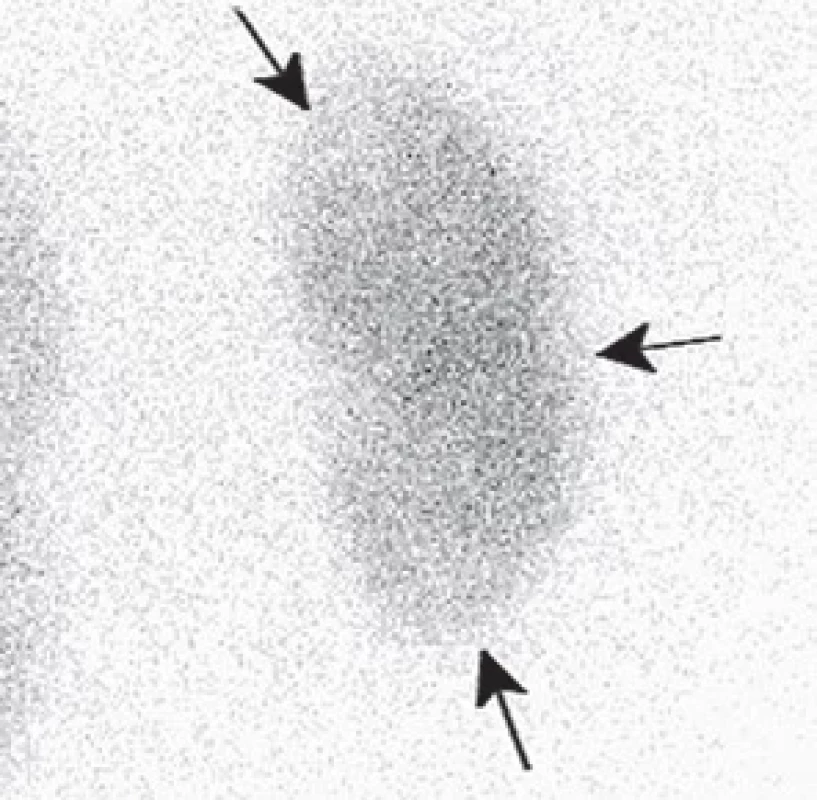 Cílený obraz pravé ledviny pomocí kolimátoru pinhole u téže pacientky s redukcemi funkční tkáně při obou pólech ledviny a s drobným zářezem ve střední třetině laterálně odpovídající stupni gradingu G3