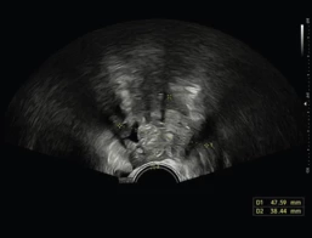 Transvaginální ultrazvuk malé pánve-heterogenní expanze velikosti 39 × 38 × 44 mm v oblasti levého ovaria. Fig. 4. Transvaginal ultrasound of the small pelvis heterogeneous expansion 39 × 38 × 44 mm in size in the region of the left ovary.