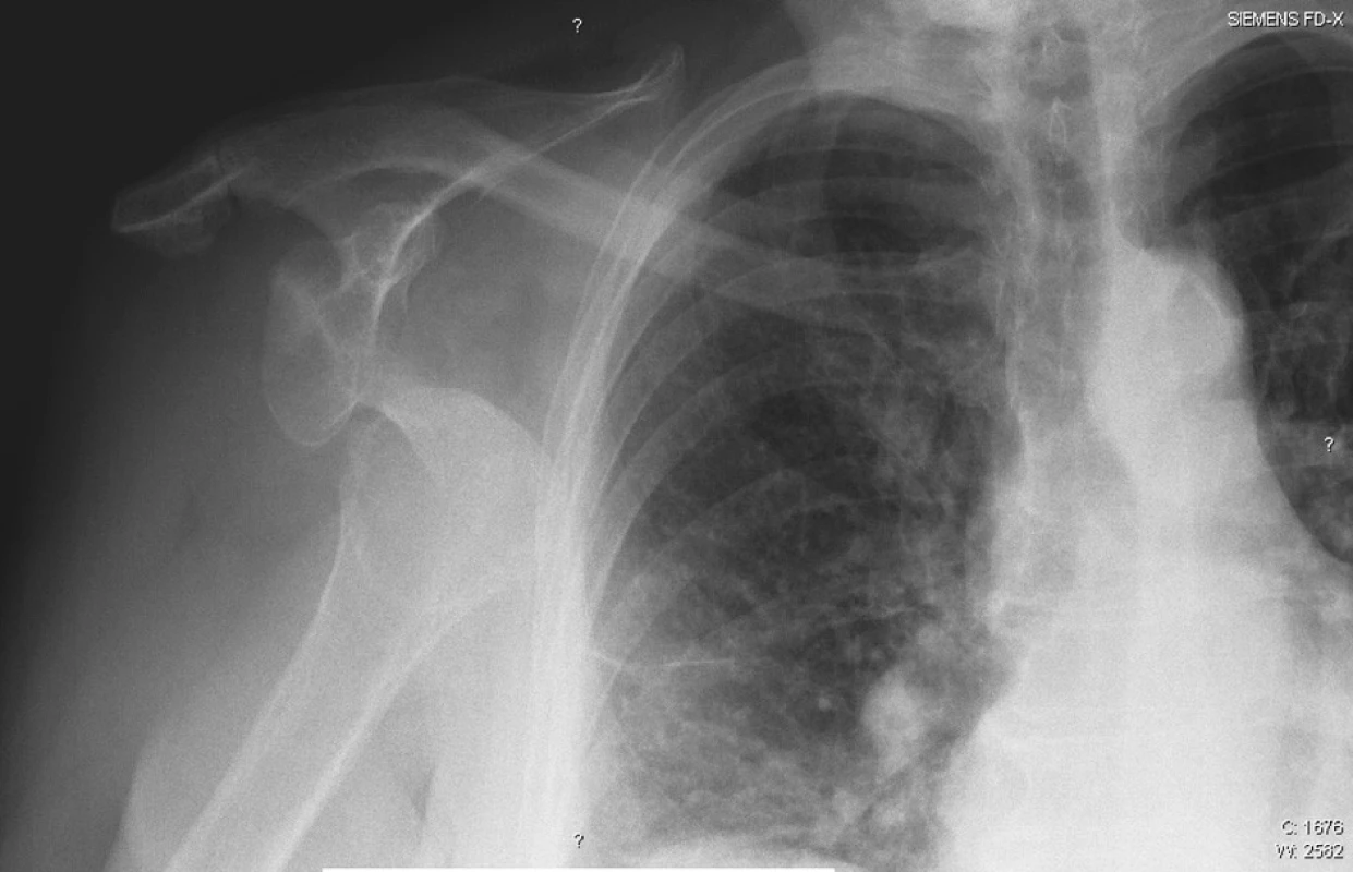 Předozadní projekce pravého ramenního kloubu před repozicí
Fig.1. A-P view of the right shoulder prior to repositioning