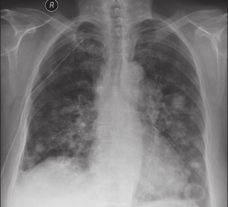 RTG plic – mnohočetné metastázy angiosarkomu
Fig. 2. Chest X-ray – multifocal metastases of angiosarcoma