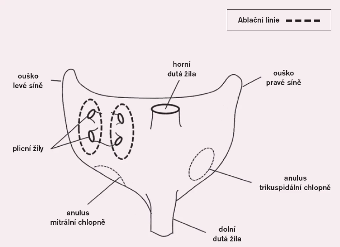 Schéma izolace plicních žil.