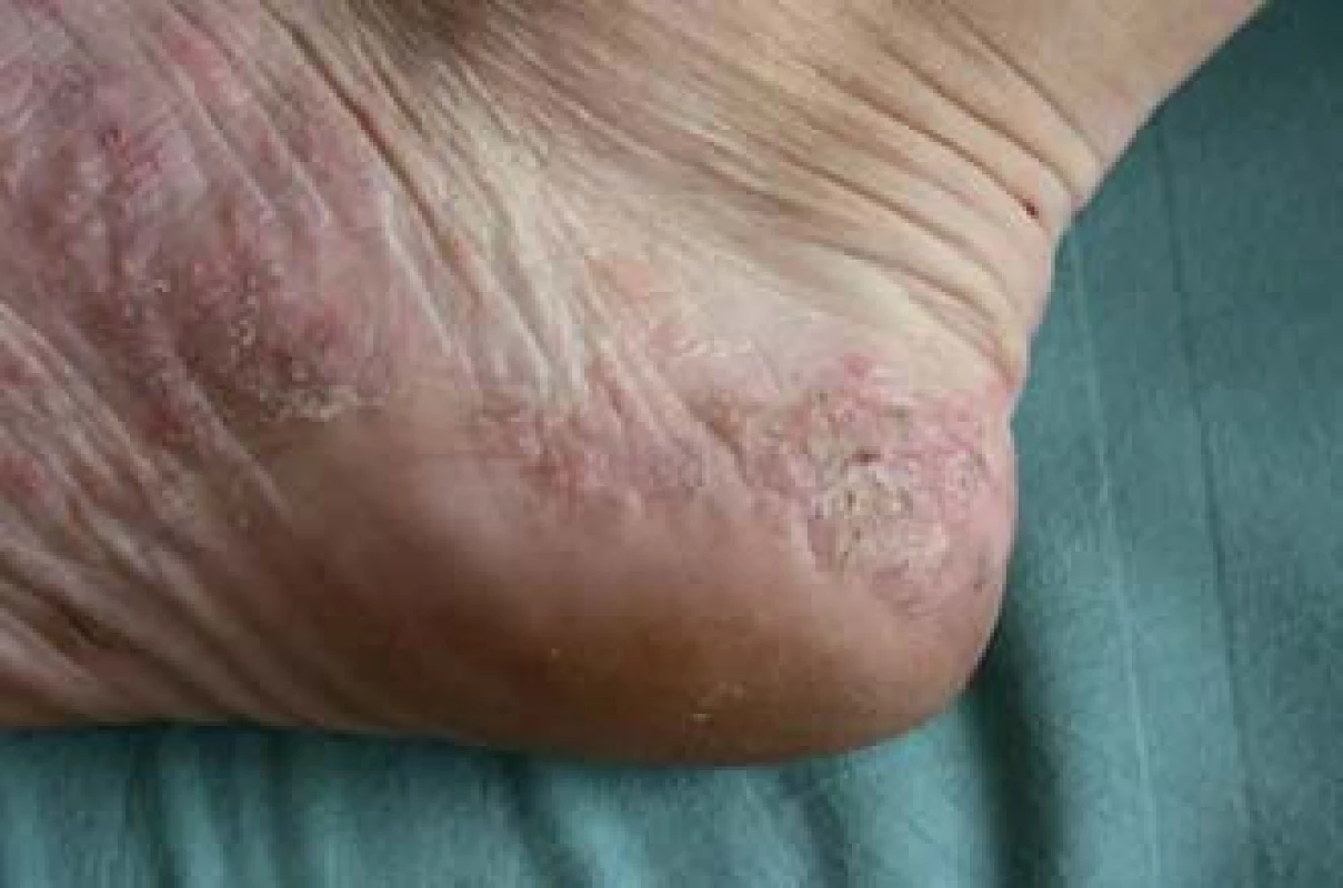 Palmoplantární pustulóza.
Fig. 8. Palmoplantar pustulosis.