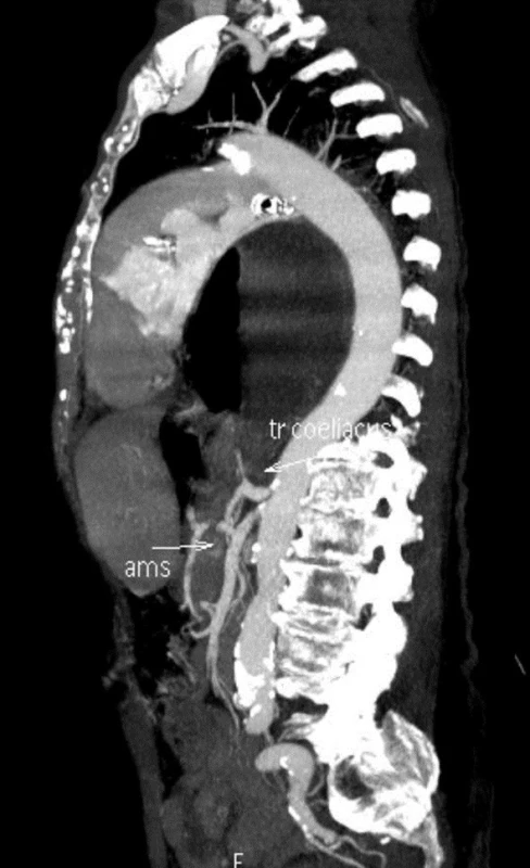 Sagitální CT snímek
Fig. 13: Sagittal CT image

