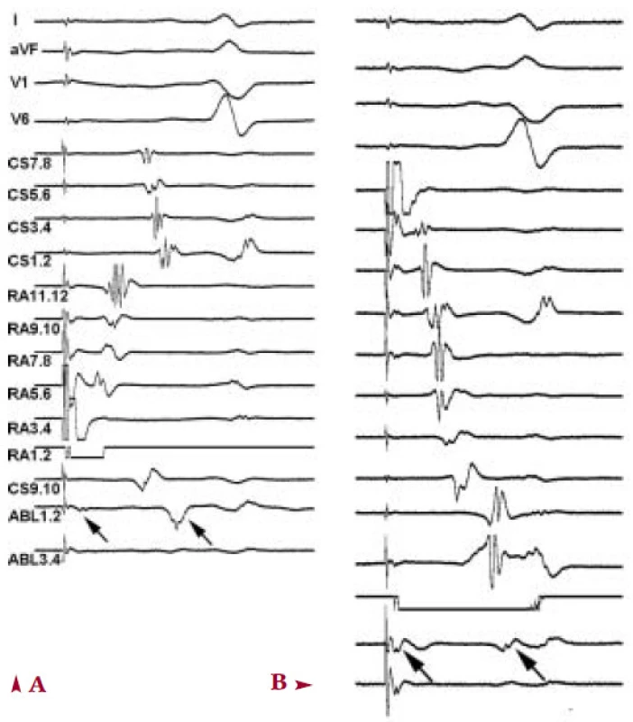 Ukázka EKG záznamu (svody I, aVF, V1, V6) a nitrosrdečních elektrogramů z oblasti koronárního sinu (CS 1.2 až CS 9.10), pravé síně (RA1.2 až RA 11.12) a ablačního katétru (ABL 1.1 a 3.4) při stimulaci z dolní části pravé síně (bipól RA 1.2).
