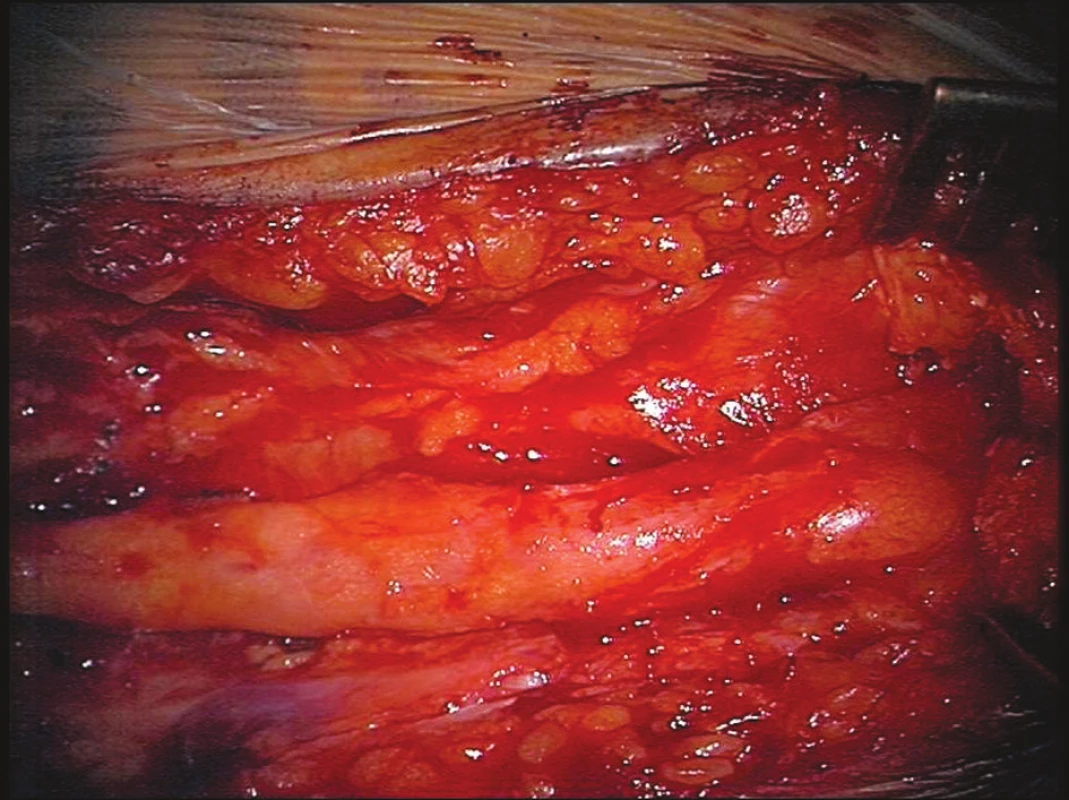 Stav po exstirpaci Bakerovy cysty
Fig. 4. Condition following extirpation of the Baker’s cyst