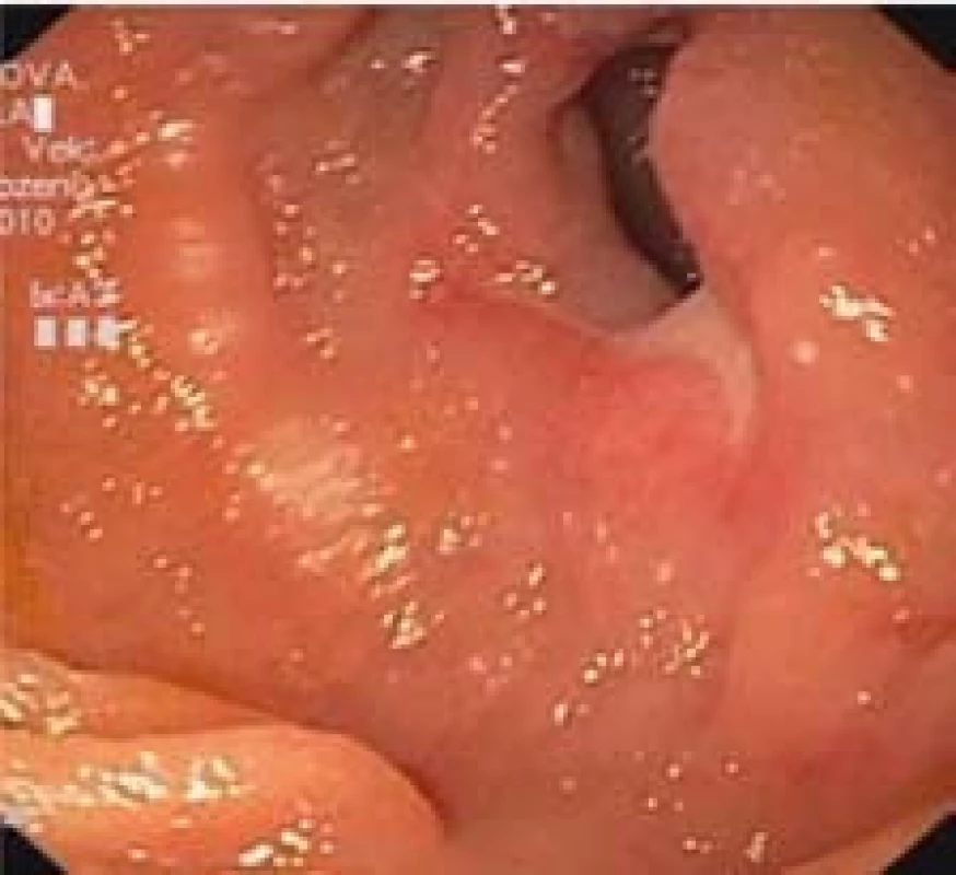 Hluboká ulcerace se stenózou lumen jejuna.
Fig. 4. Deep ulceration with luminal stenosis of the jejunum.
