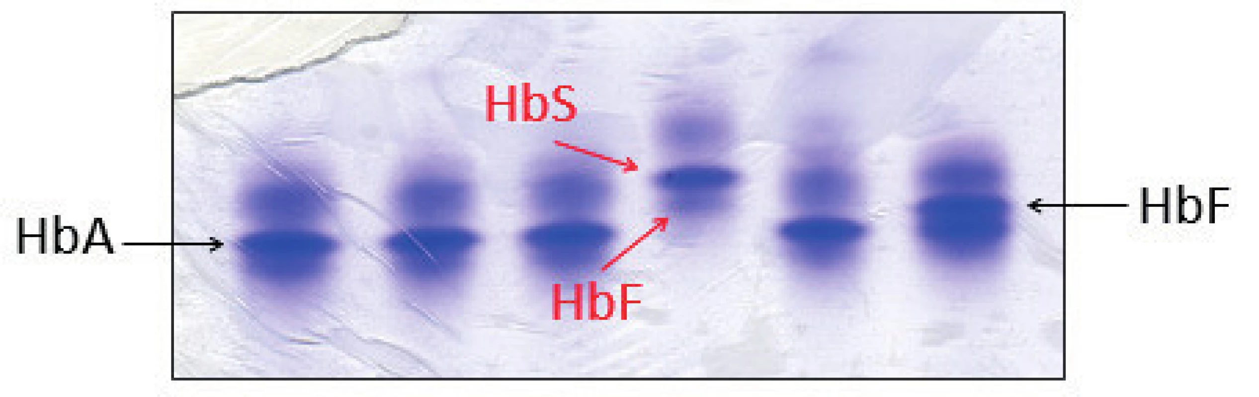 Detekce HbS proteinovou elektroforézou na polyakrylamidovém gelu barveném Coomasie blue. Červené šipky označují frakce HbS a HbF jako jediné hemoglobiny u pacienta se srpkovitou anémií, což odpovídalo zjištěnému genotypu pacienta. (Hemato-onkologická klinika, FN a LF Univerzity Palackého v Olomouci)
Fig. 5. Detection of HbS by protein electrophoresis on polyacrylamid gel stained with Coomasie blue. Red arrows indicate the HbS and HbF fractions as the only hemoglobins in a patient with sickle cell disease, which corresponds with patient’s genotype.