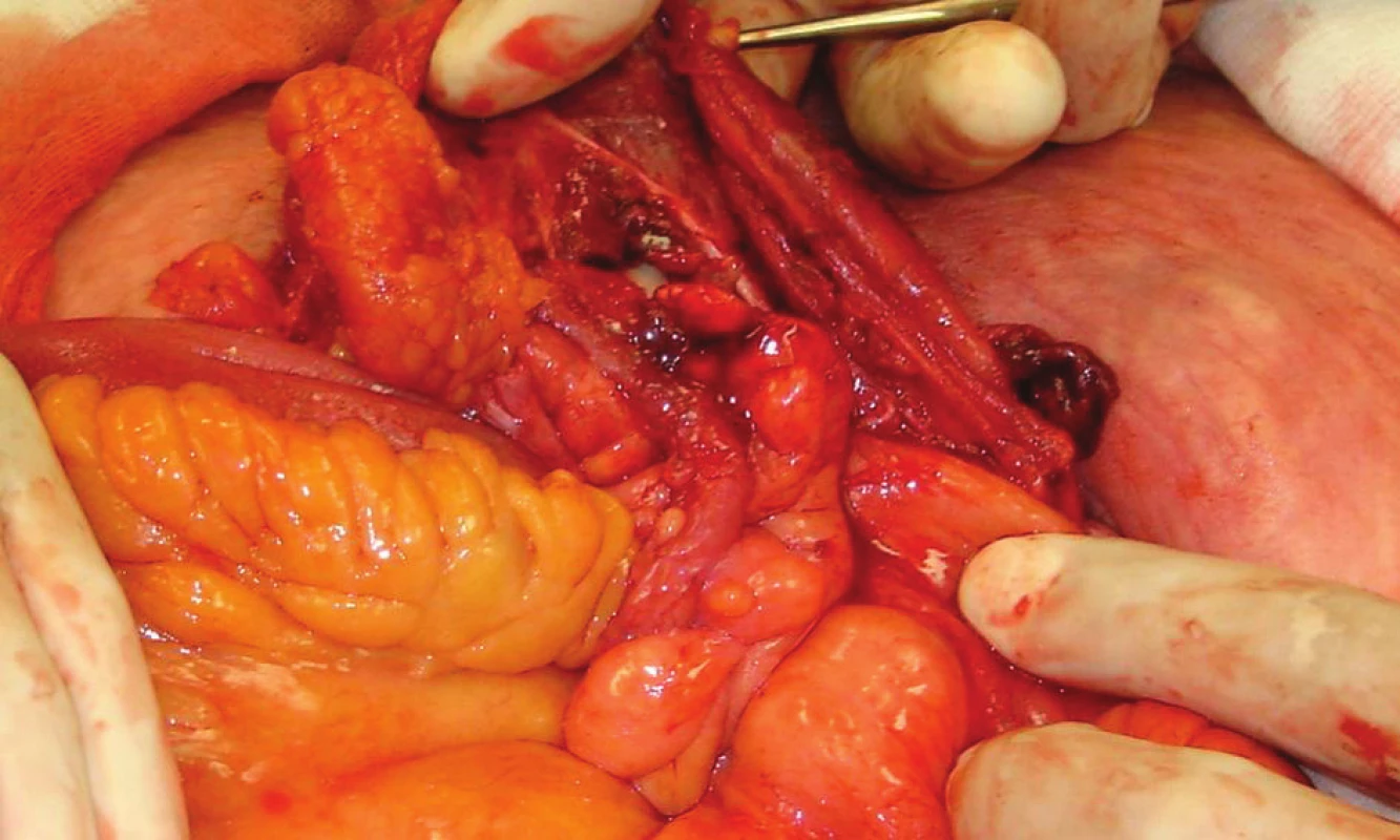 Apendix v otevřeném kýlním vaku
Fig. 2. Apendix in the open hernia sac