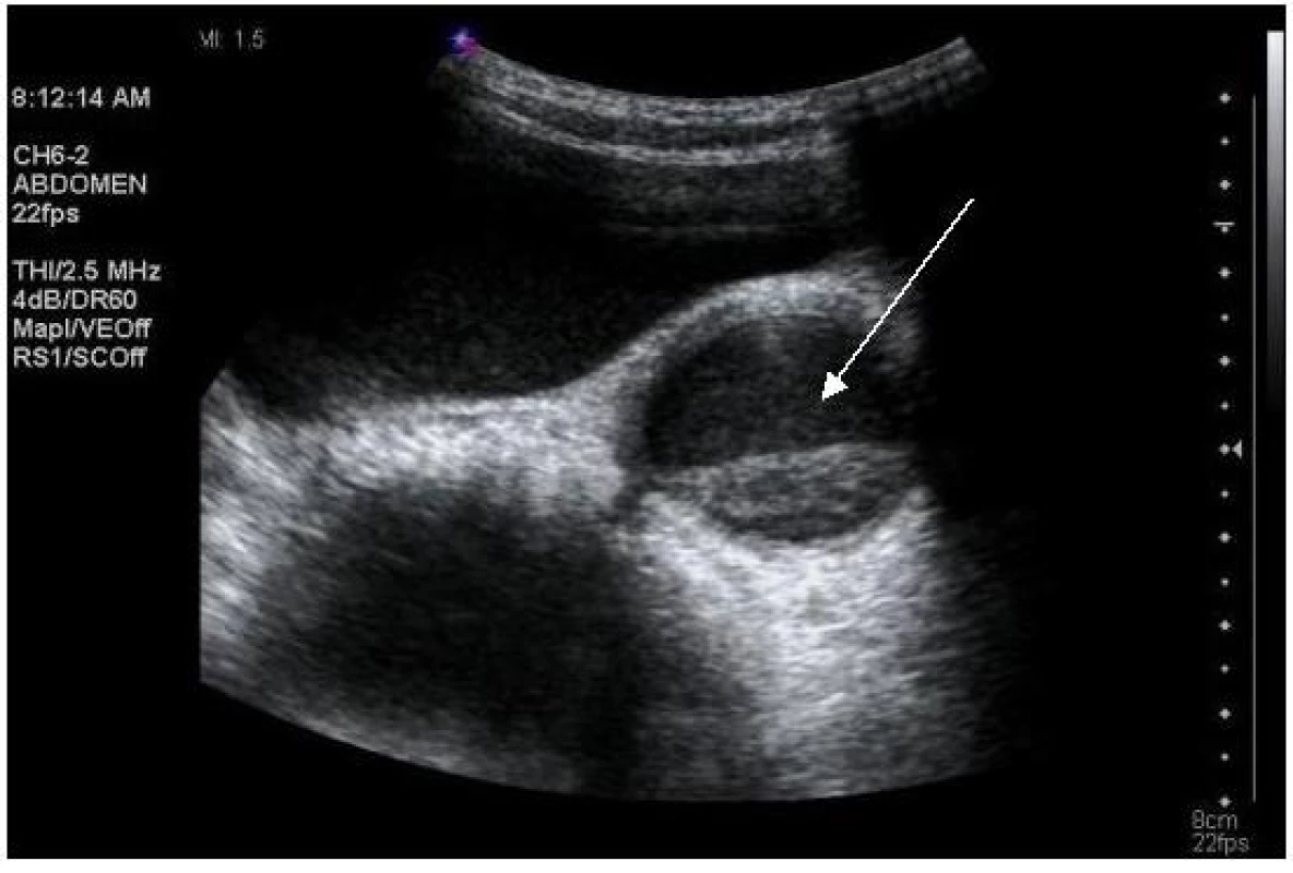 Ultrasonografie, pacient č. 5; šipka ukazuje dilatovaný močovod s abnormální echogenitou jeho náplně.

Fig. 2. Ultrasound, patient No 5; moderate dilation of the ureter with abnormal echogenicity in the lumen (arrow).