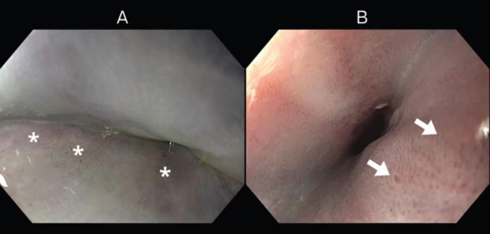 Esophageal endoscopy images.