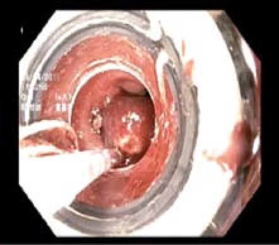 Endoskopická resekce technikou s ligátorem.
Fig. 3. Endoscopic resection using a ligator.
