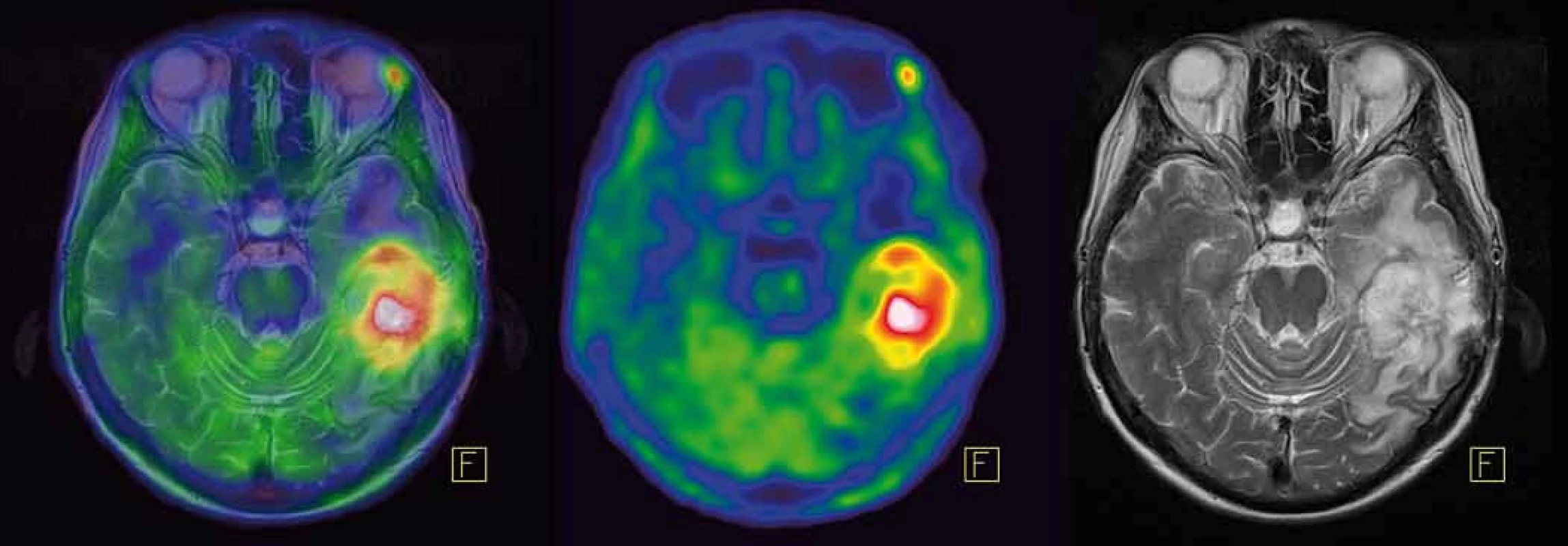 [<sup>11</sup>C]methionin-PET a fúze s MRI mozku.
Recidiva gliomu temporálně vlevo vykazuje vysokou akumulaci [<sup>11</sup>C]methioninu.