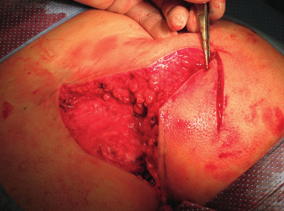 Konstrukce fasciokutánního laloku
Fig. 3: Fasciocutaneous flap construction