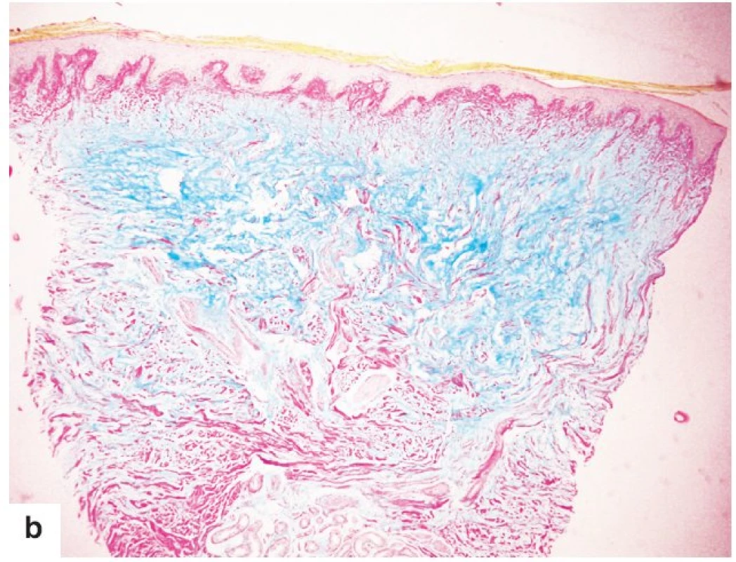 Histologický nález pretibiálního myxedému
