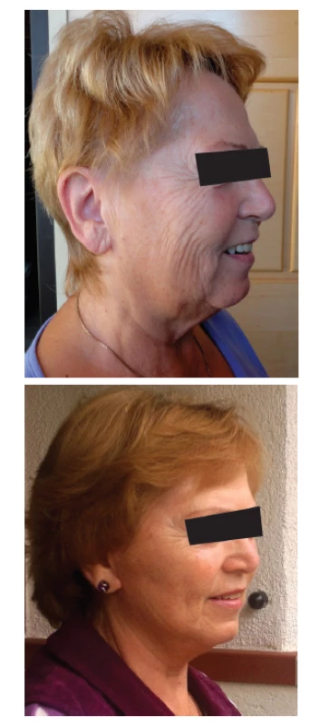 Facelifting u pětašedesátileté ženy
Fig. 3: Facelift in a 65 years old female