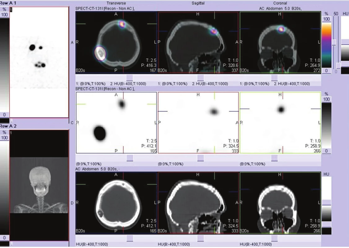 SPECT/CT hlavy – radiojod akumulující ložiska korelující s osteolytickými defekty v kalvě.