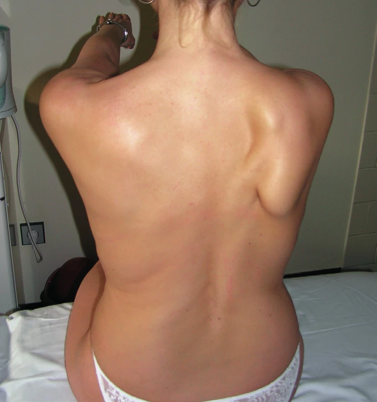 Scapula alata vpravo – odstává převážně dolní úhel lopatky.