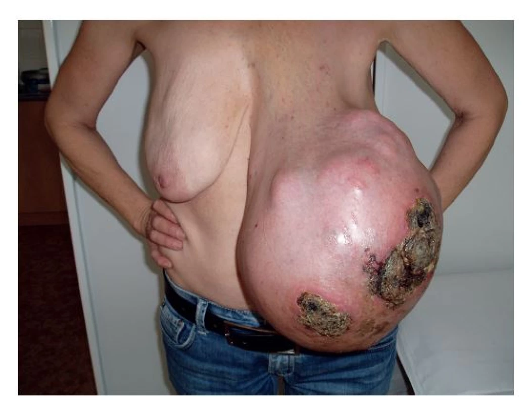 <b>Fyloidní tumor z benigní části spektra</b>
Stroma je málo celulární s minimálními atypiemi. Hematoxylin- eosin, zvětšení 100x.
<b>Fig. 1: Phyllodes tumour in the benign part of the spectrum</b>
The stroma is little cellular with minimal atypias. Hematoxylin- eosin, magnified 100x.