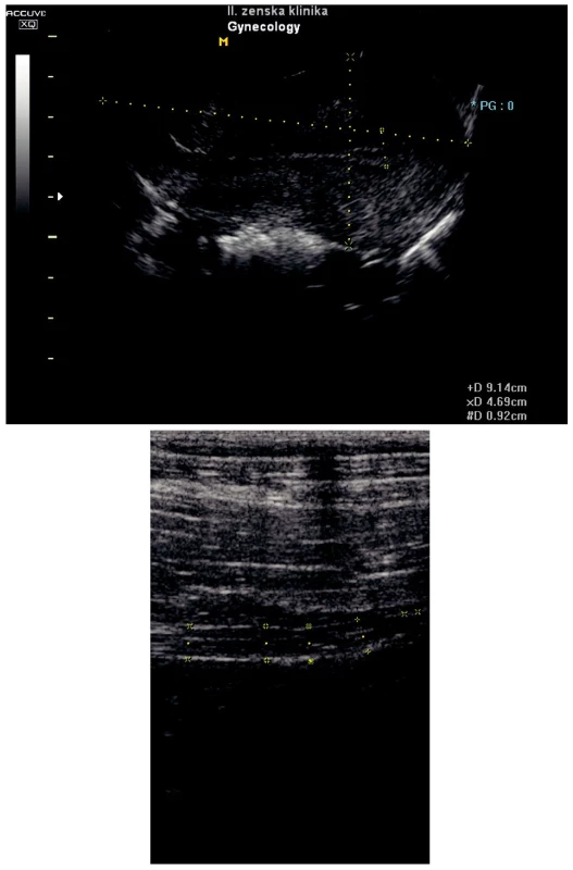 a) USG uteru v I. trimestri gravidity, 
b) USG apendixu bez zápalových zmien v I. trimestri gravidity
Pic. 3 a) USG of the womb in the first trimester of gravidity,
b) USG of the appendix without inflammatory changes in the first trimester of gestation