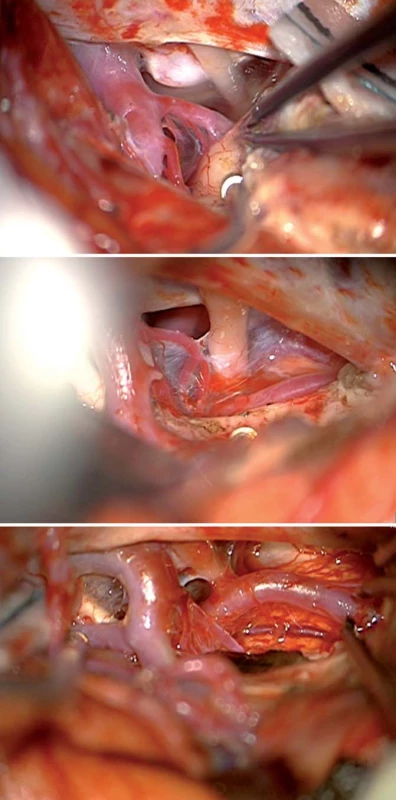 Přední transsylvijský přístup s anteromediální temporální lobektomií.
Fig. 3. Frontal trans-sylvian access to the anteromedial temporal lobectomy procedure.