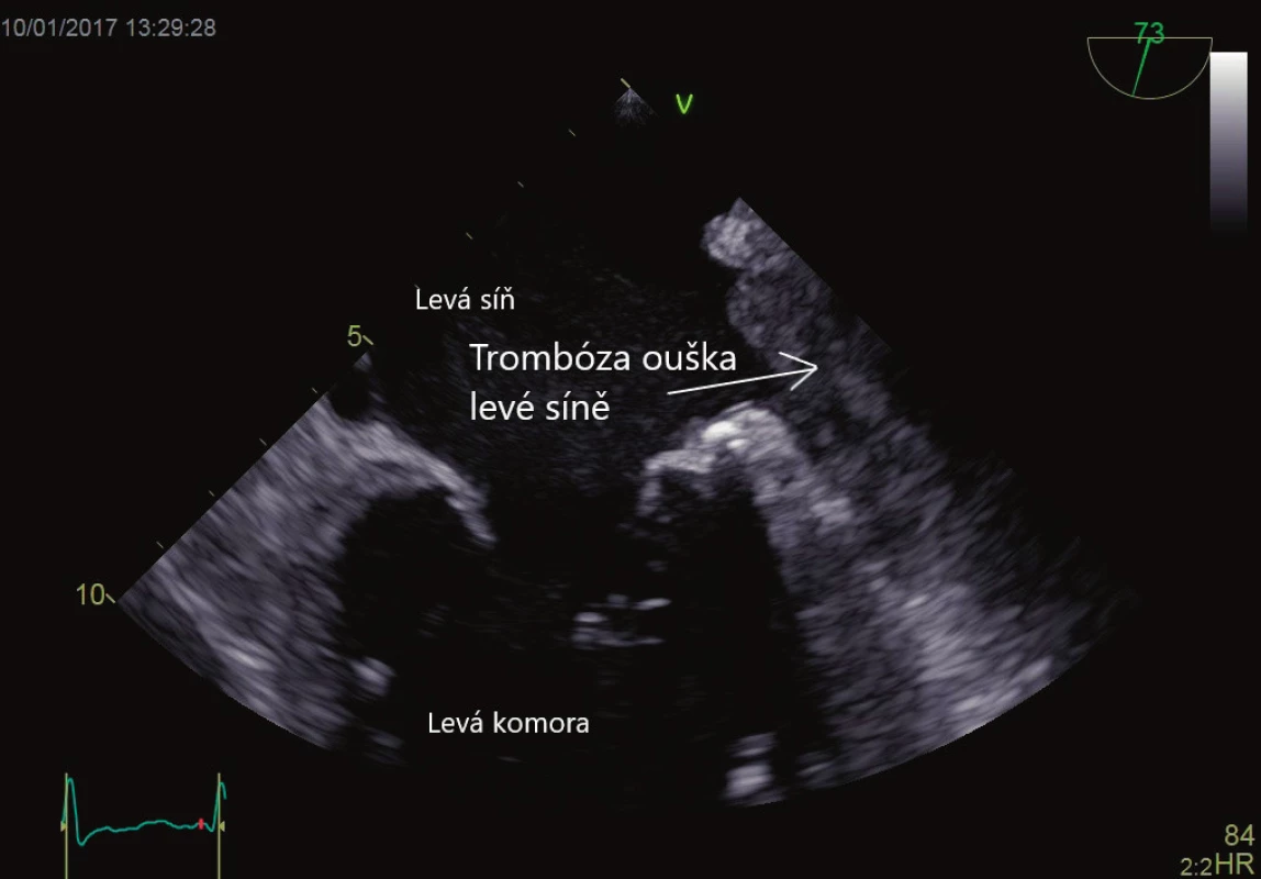Trombus v oušku levé síně. Vyšetření jícnovou echokardiografií